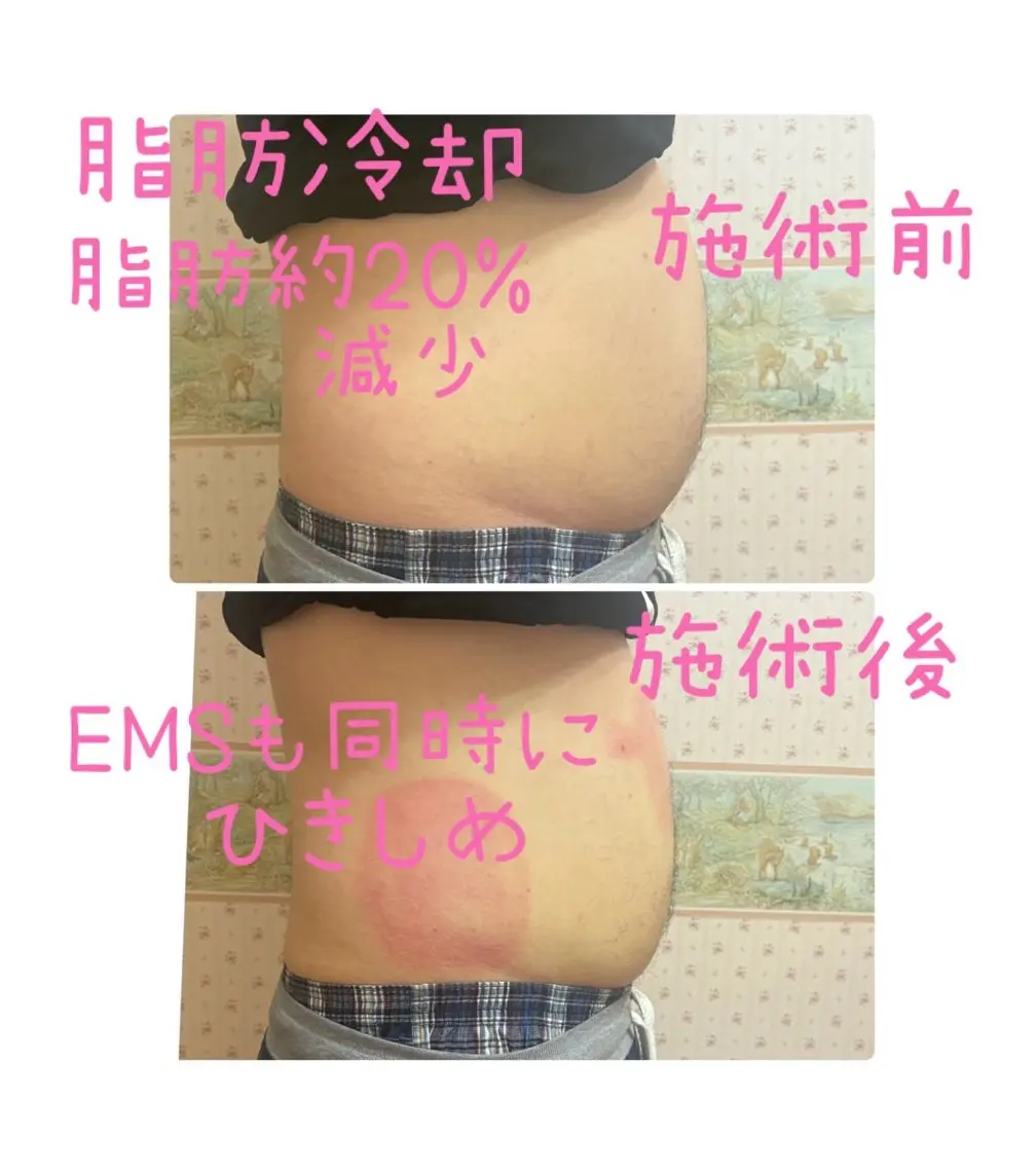 冷却スリミングケア4部位の写真