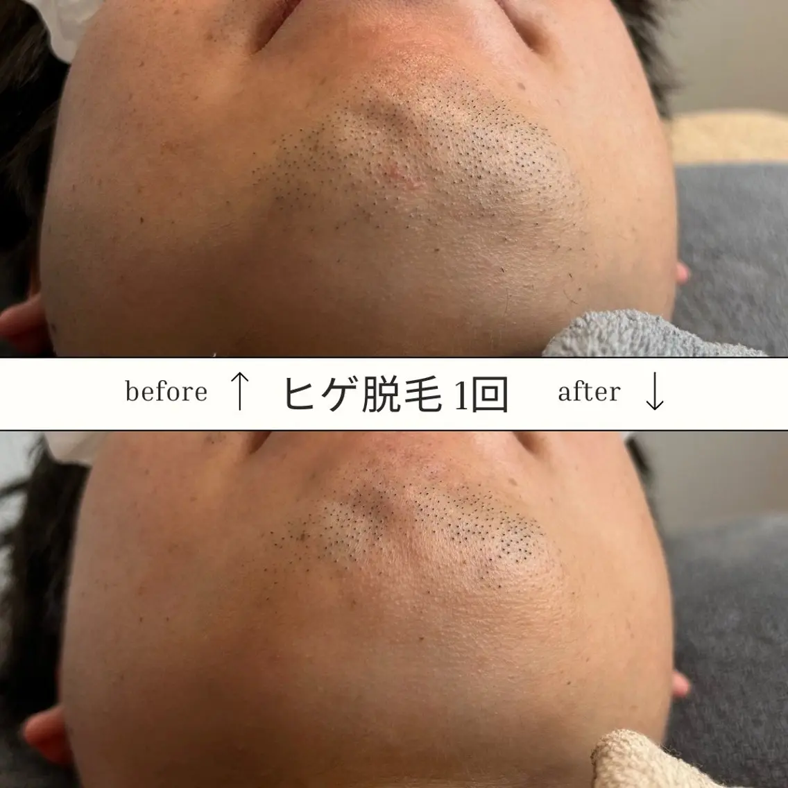 【社会人もOK！24歳以下】青髭卒業★ヒゲ全体脱毛 何度でも同価格！の写真