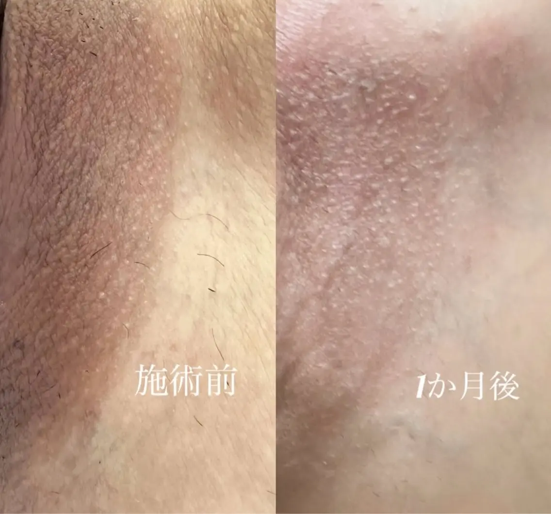 ROMA PINK 陰部 モニター定価より40%OFFの写真
