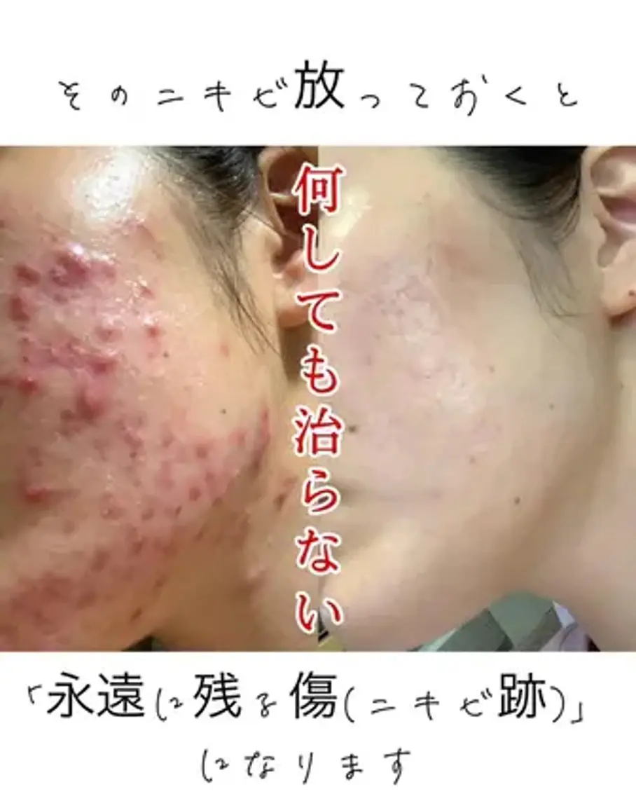 【本気改善】剥離あり韓国水光肌ハーブピーリング　27,500→8,800円の写真