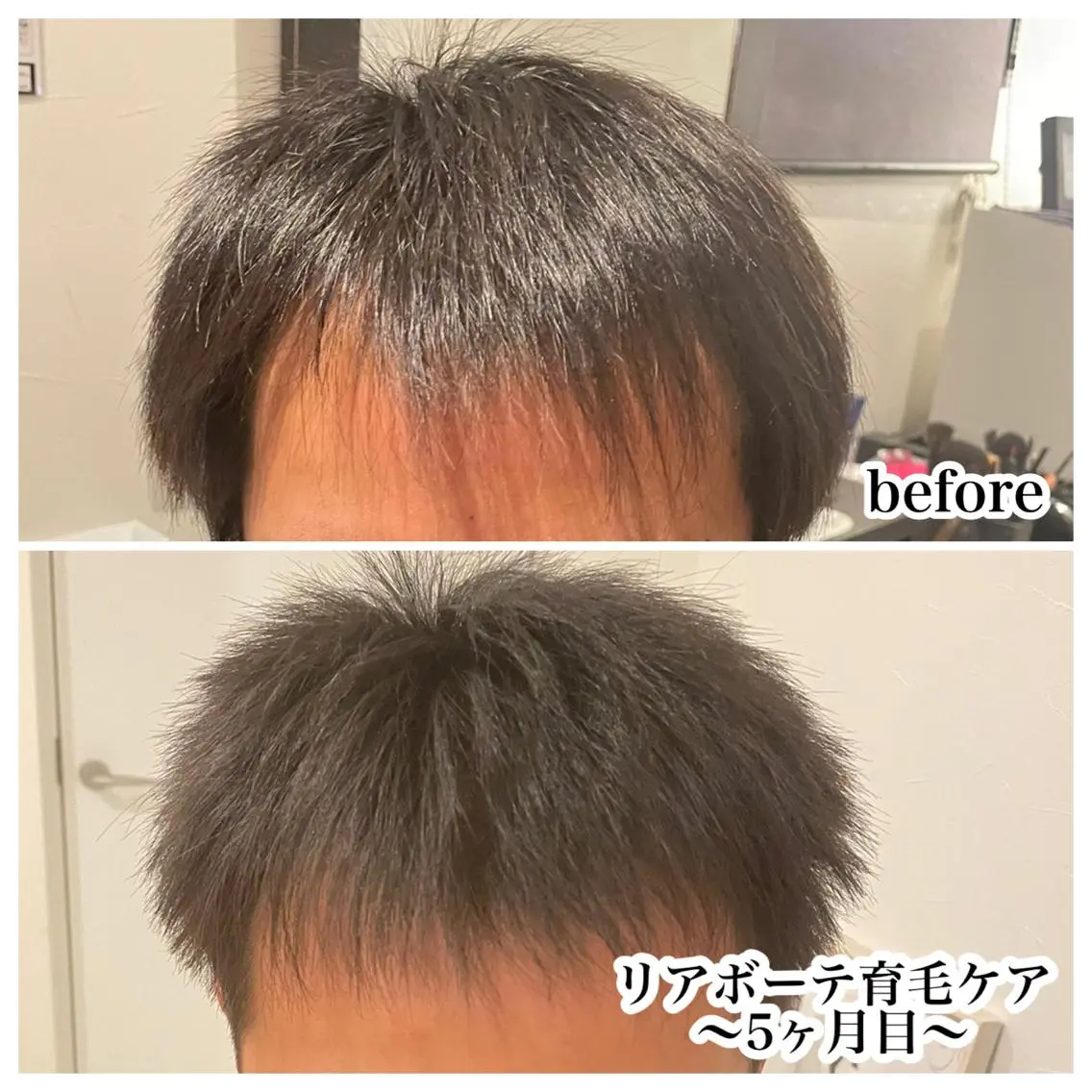 🌈薄毛&抜け毛&白髪ケア🌈凍結乾燥ヒト幹細胞培養液高速ジェットエアー導入⭐︎ACトリートメント60分の写真