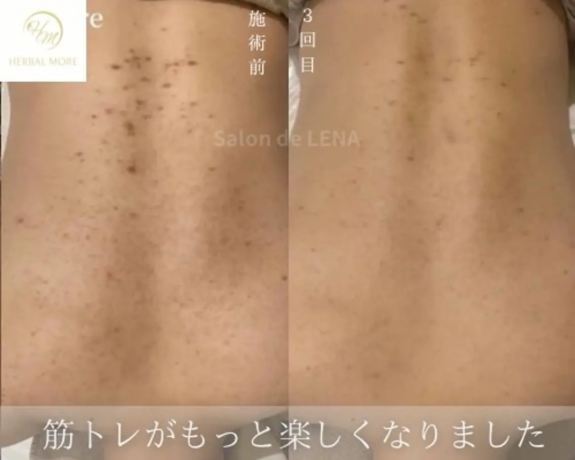 💫🌿【ミニモ学割🧑🎓】好きな箇所から選べる❣️全身ハーブピーリング(剥離なし)🌿💫の写真