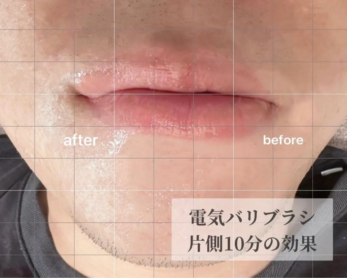 電気バリブラシの写真