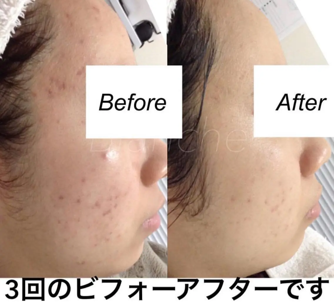 セミロング カラー パーマ ヘアアレンジ キッズ ネイル マツエク・マツパ エステ リラク 都度払い肌質改善 &脱毛Blancheのエステ・リラクイメージ