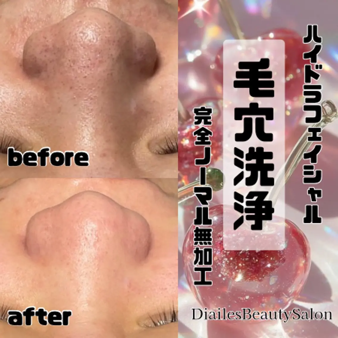 🫧鼻だけ毛穴洗浄🫧1回でも効果👍⏰30分の写真