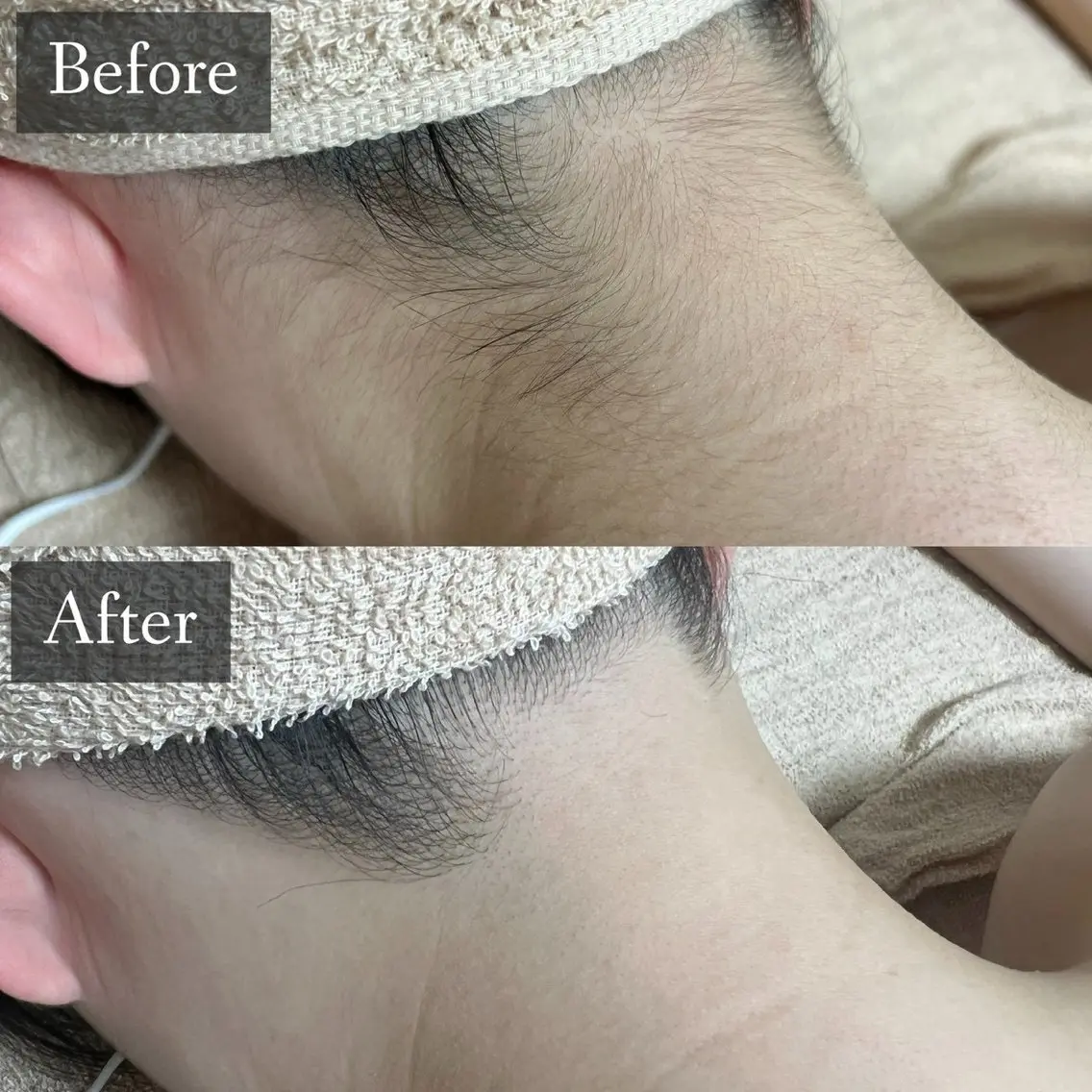 🚺【レディース背面脱毛】(補足説明を確認してください)1回のみの使用可能です⭐️口コミ→ドライヘッドの写真
