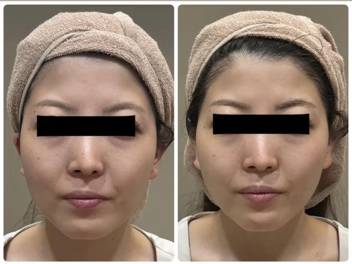 【美肌×脱毛】フェイシャルと顔脱毛が同時に叶う✨毛＆毛穴の両方にWの効果で毛穴レス肌🫧シェービング付きの写真