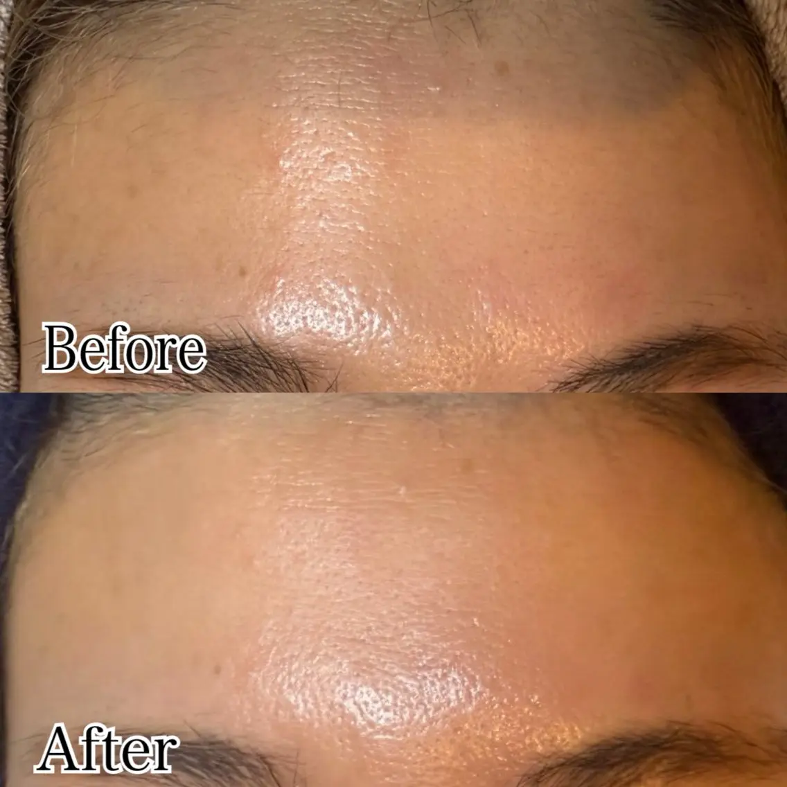 フェイシャルWax脱毛の写真