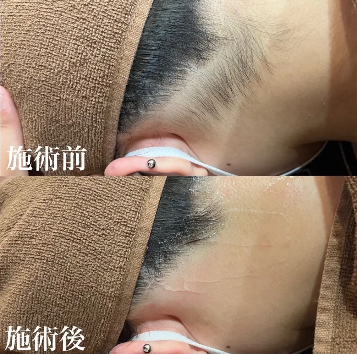 【シェービングのみ】うなじ・背中全面シェービング、プラセンタ保湿付き🤍の写真