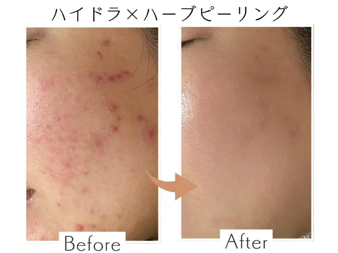 【リピート】水素ハイドラ×剥離ありハーブピーリング🌿の写真