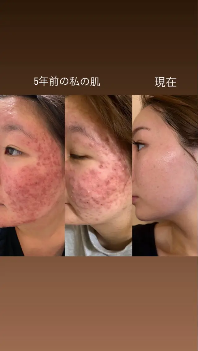 「エンビロン無料カウンセリング」(30分)エンビロン化粧品10%offニキビ、肌荒れ、乾燥、敏感、ツヤ肌ご相談ください✨の写真