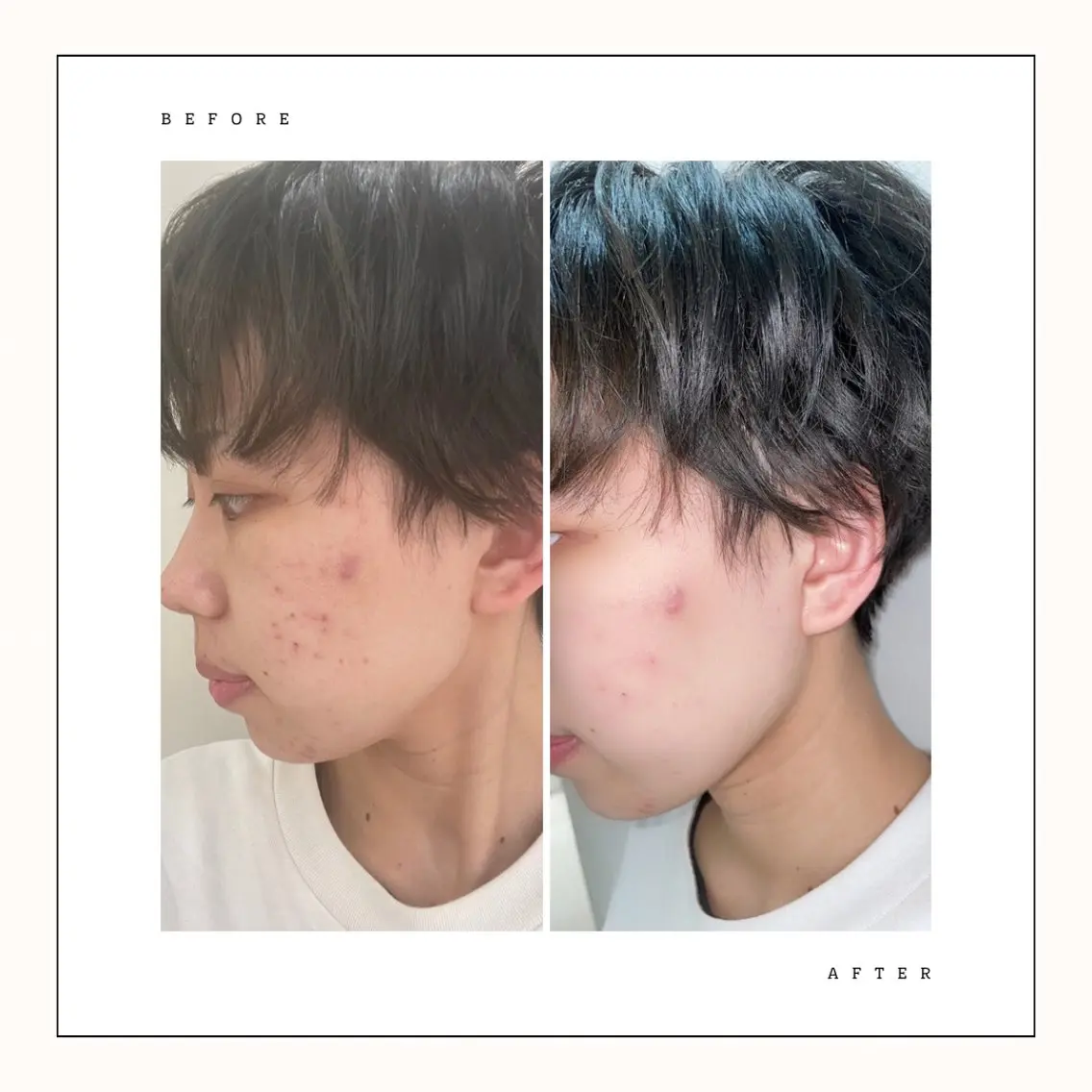 【ニキビ肌専用】1回で赤み落ち着く集中ケア✨️皮脂吸引➕ニキビ鎮静パックの写真
