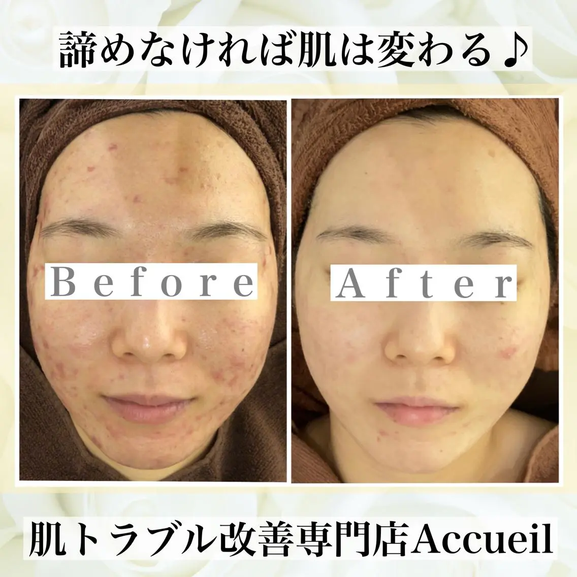 ミディアム カラー パーマ ヘアアレンジ メンズ キッズ ネイル マツエク・マツパ エステ リラク ニキビ・肌質改善専門 ♡人生が変わるサロンのエステ・リラクイメージ