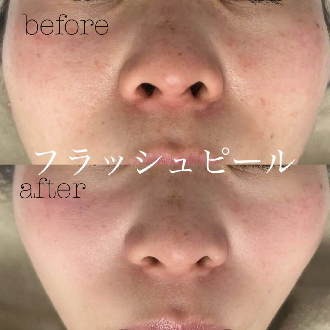 【💞リピーター様💞】フラッシュピール✨の写真