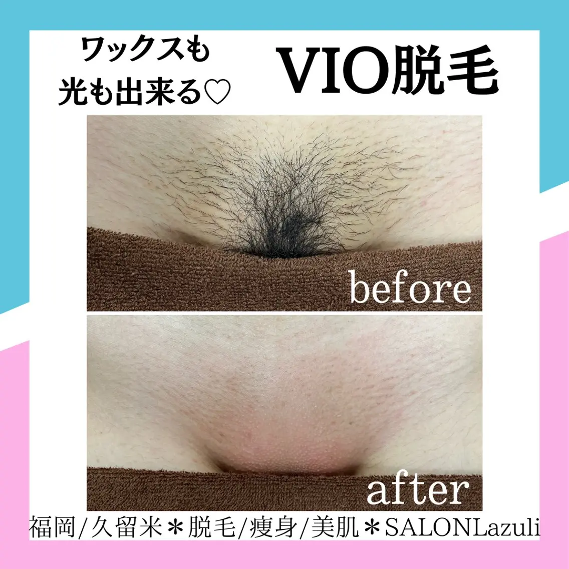 【新規女性/大人女性の身だしなみ/介護脱毛】VIOワックス+光脱毛体験¥8980の写真