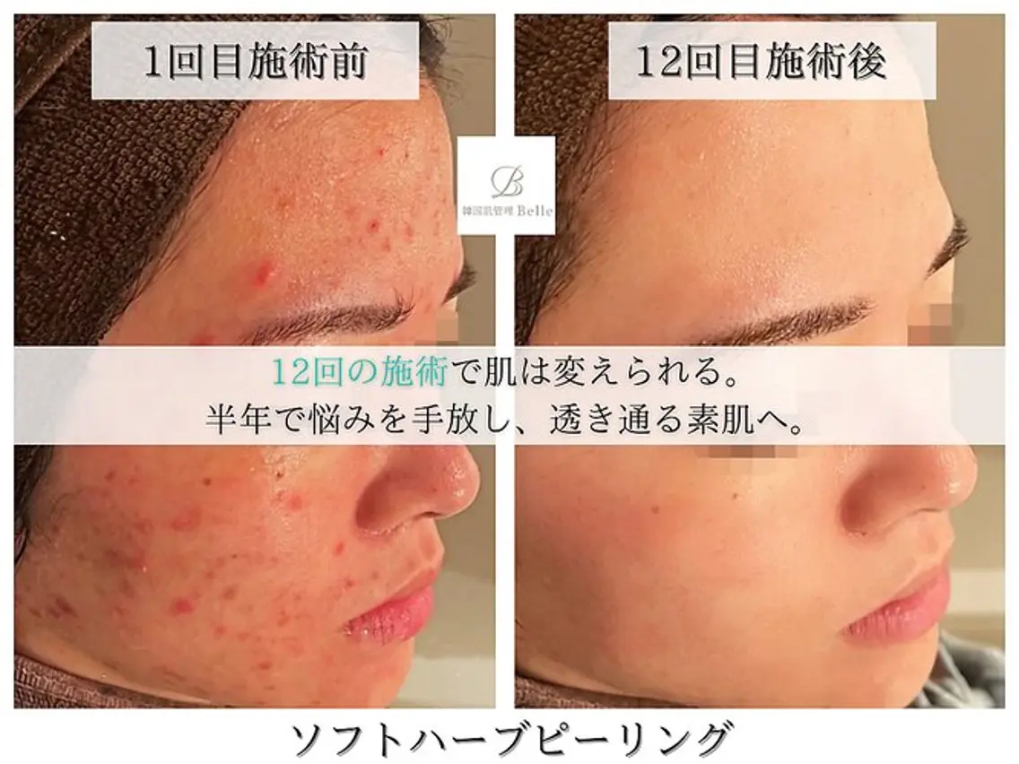 大人気!!【エステダーマペン+ハーブピーリング】より早く美肌にしたい方にオススメメニューの写真