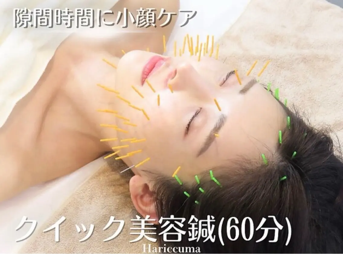 <クイック美容鍼> 美容鍼 ¥8500の写真