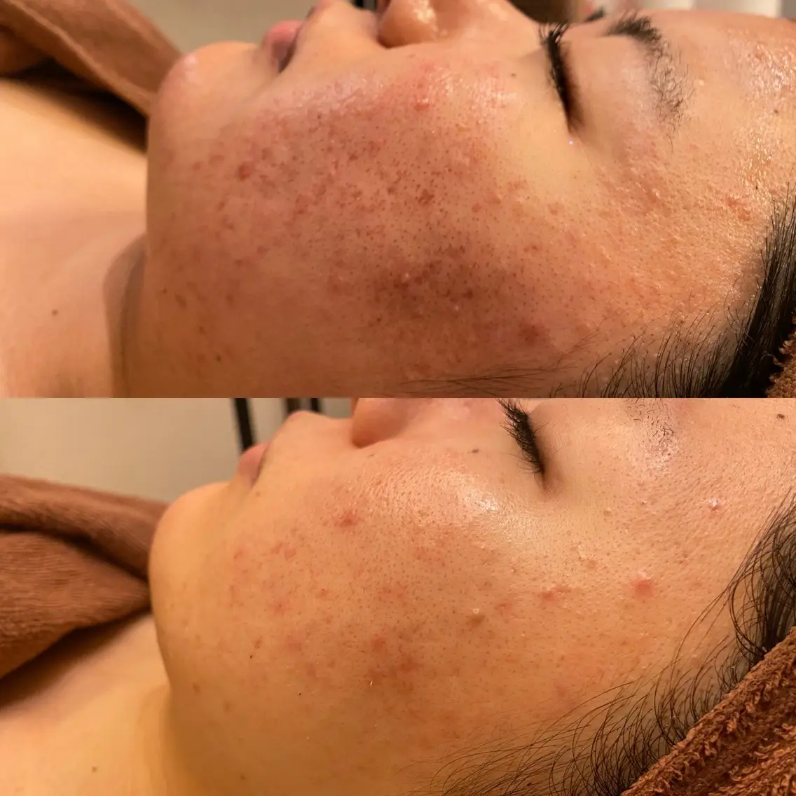 ハーブピーリング専門 毛穴洗浄❤️眉waxのエステ・リラクイメージ