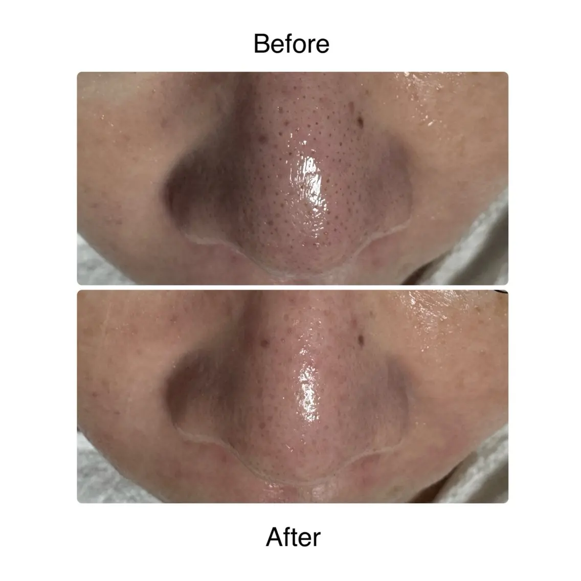 気になる毛穴👃集中ケアコースの写真