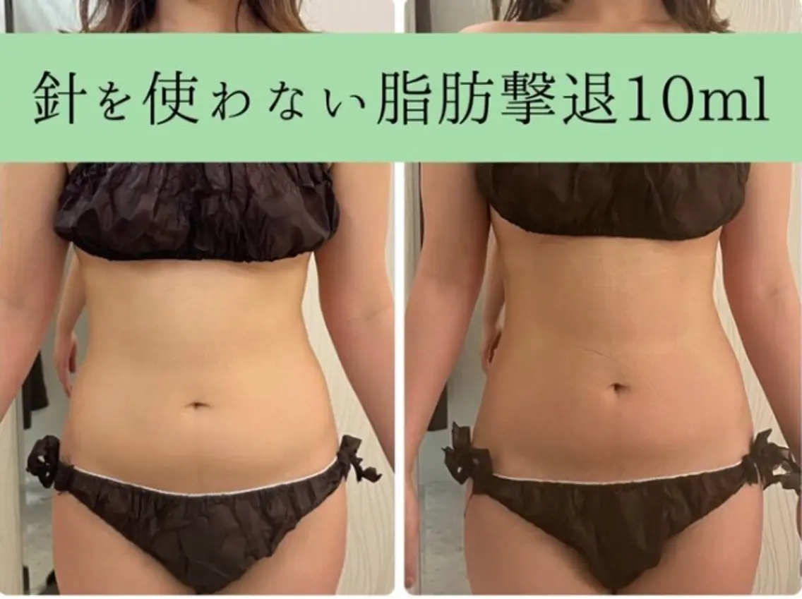 👑人気NO.1👑針を使わない脂肪撃退‼️後戻りゼロ🫶 +ハイパーナイフEX 🔥 【お好きな箇所1部位集中】の写真