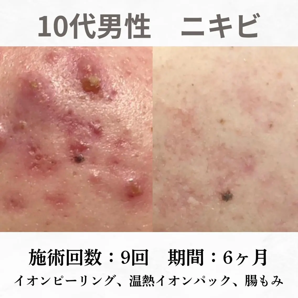 重度ニキビ専門🌼 ダウンタイムなしのエステ・リラクイメージ