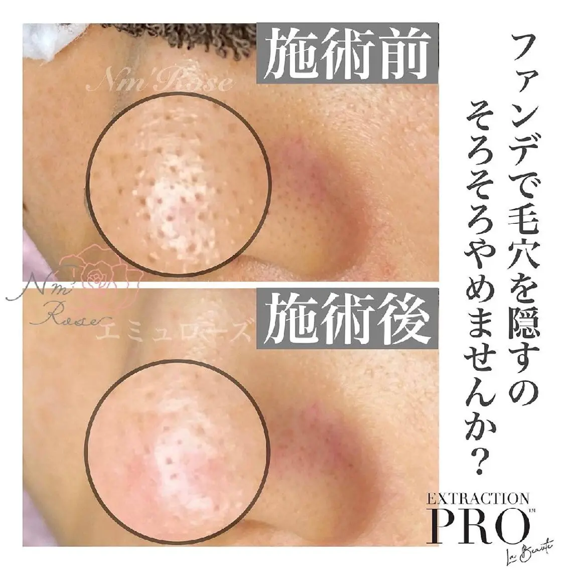 【夏の肌悩みNo.1】べたつく毛穴ごっそり!毛穴エクストラクションの写真