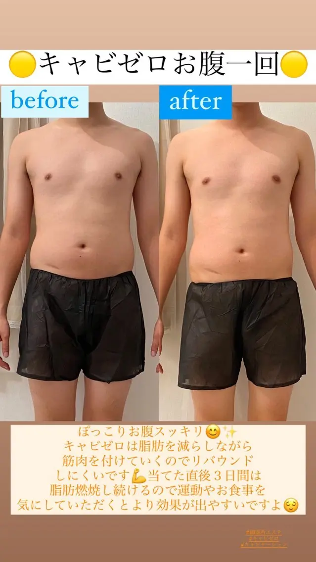 ⭐️速攻痩せダイエット痩身❤️‍🔥キャビゼロ60分の写真