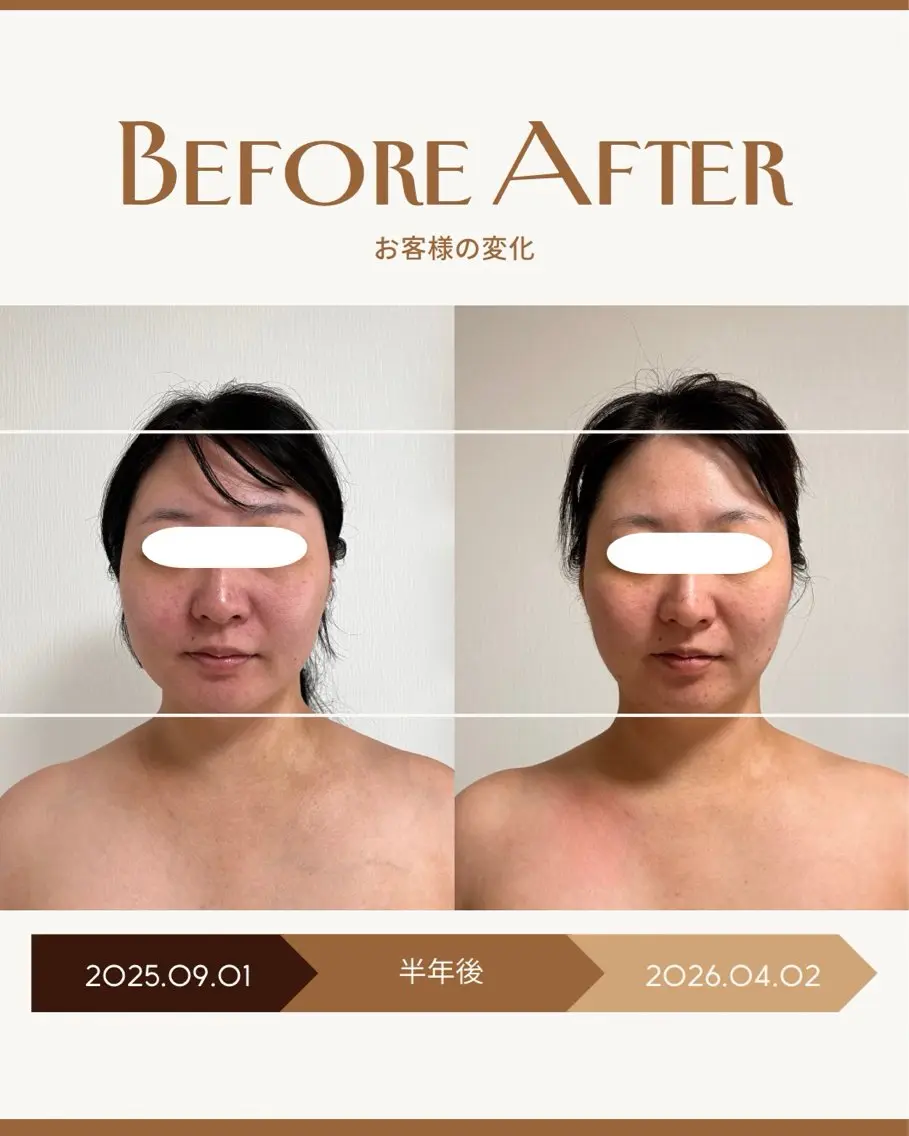 🌿 3ヶ月間(6回来店条件)90分【顔むくみ解消/の余白をなくす小顔ヘッドスパ】の写真