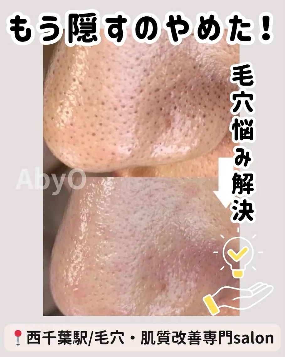 黒ずみ毛穴お掃除コース　【5月まで新生活応援📣キャンペーン中】の写真