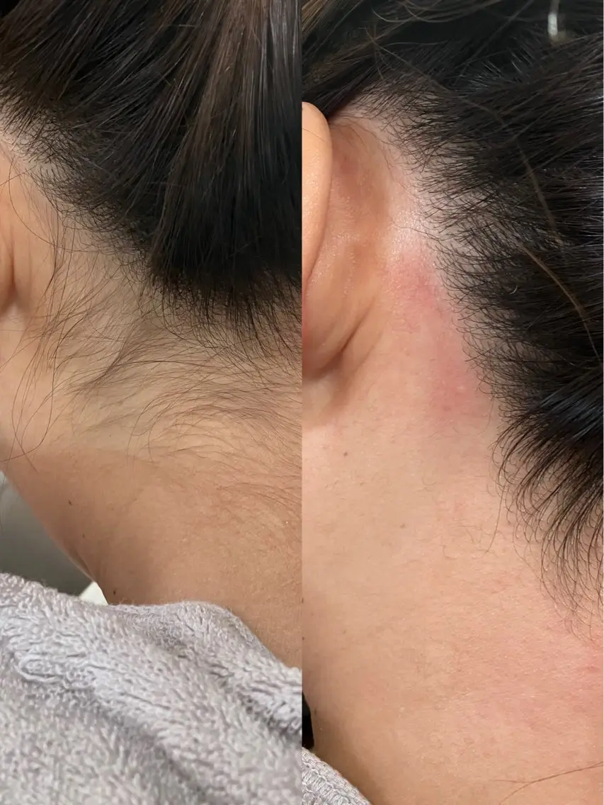 パーツwax🪄『うなじ』•『おでこ』•『もみあげ』いずれか1箇所wax🍯🪄の写真