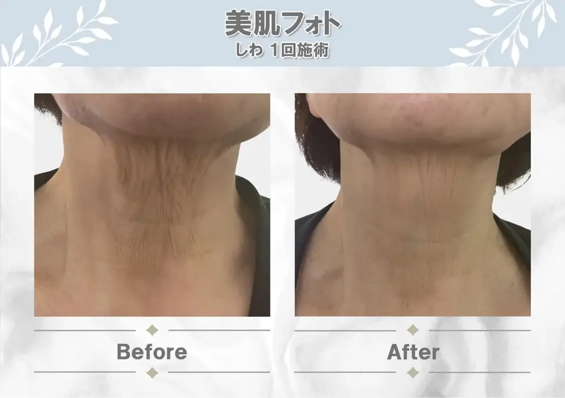 ✨美肌フォト✨首🦋の写真