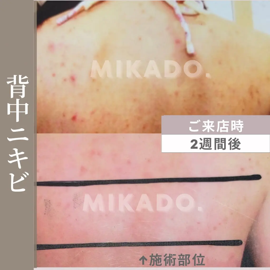 【ブライダルに】ハーブピーリングで背中のニキビケアに90分¥38500→¥30800の写真