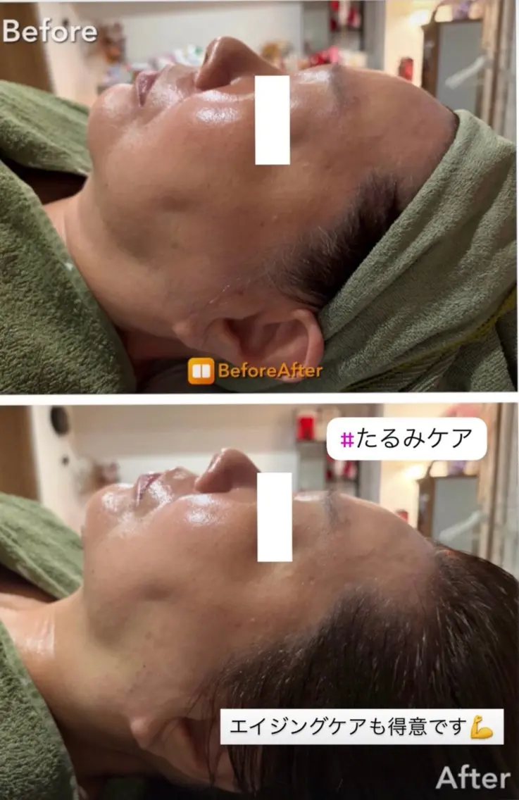 Meupニキビ専門店 背中/ハーブ/肌管理のその他イメージ