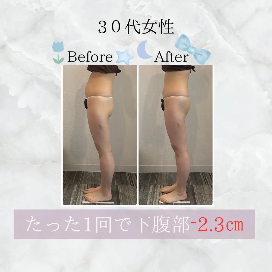 【痩身/上半身】ハイパーナイフ60分の写真