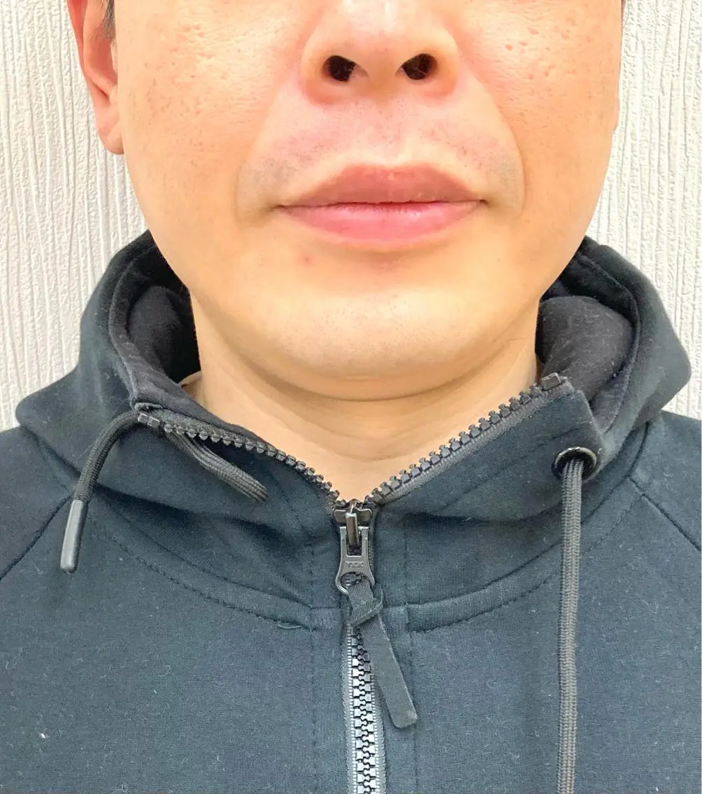 【メンズ脱毛】人気のヒゲ脱毛🎉ヒゲ剃り要らずのキレイ肌へ✨の写真