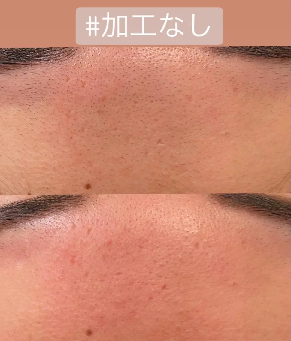 おでこのワックス脱毛の写真