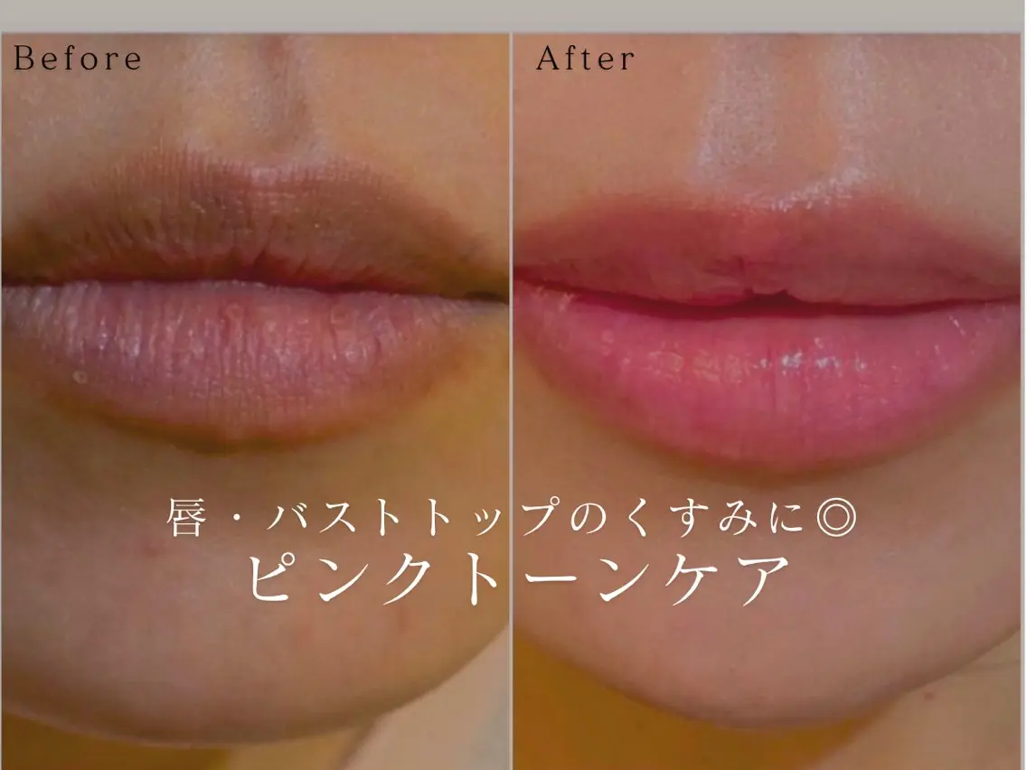 NEW【唇・バストトップをピンクに】話題のピンクトーンケア体験🎀💗1部位¥5000の写真