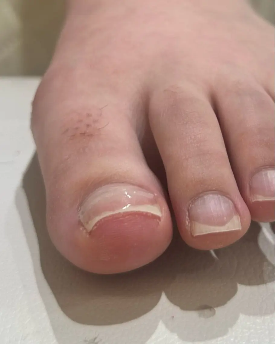 【巻き爪ケアメニュー】プレート¥2750/ジェル¥2200の写真
