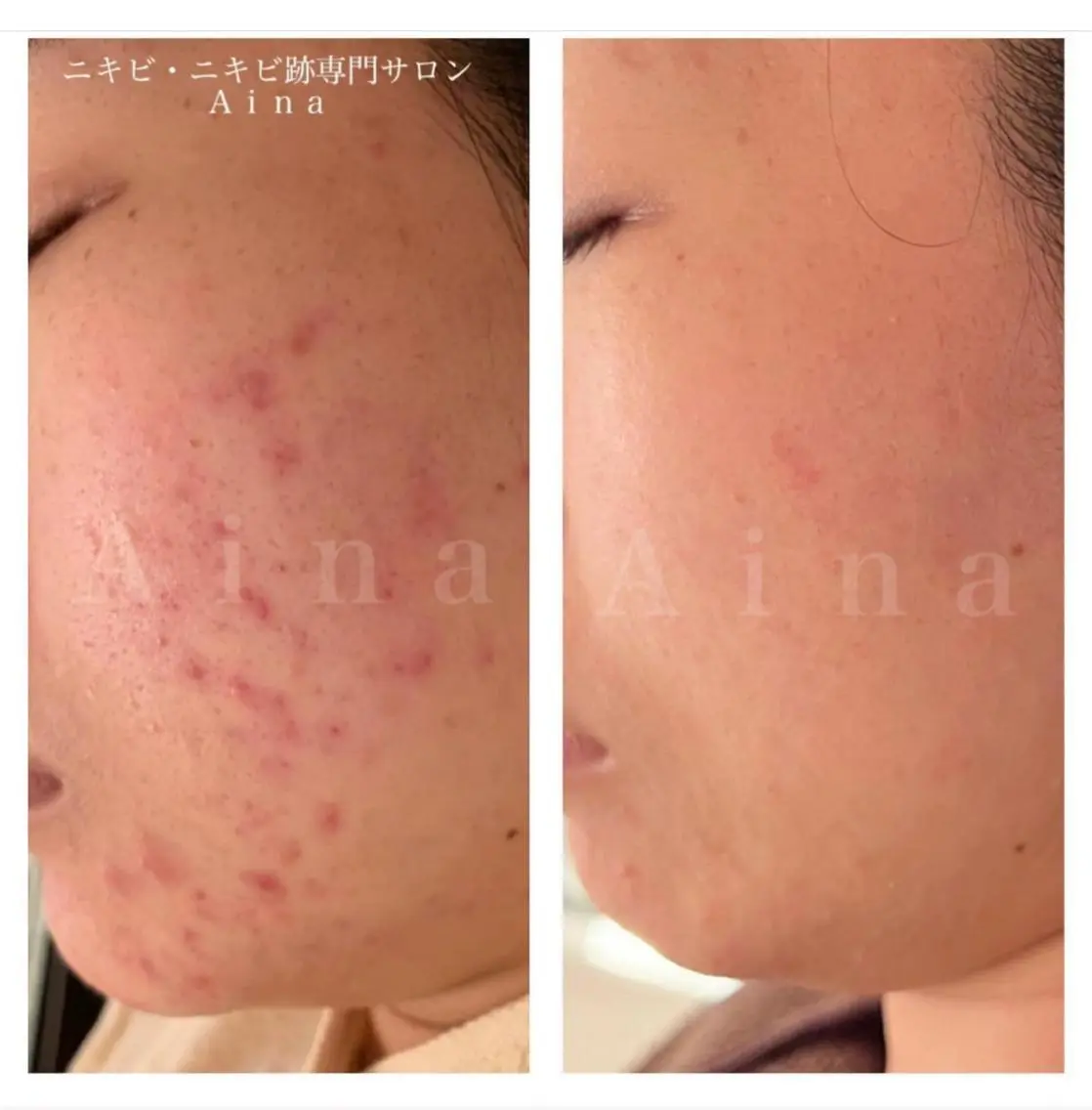 ロング カラー パーマ ヘアアレンジ メンズ キッズ ネイル マツエク・マツパ アイブロウ 卒業式のヘアスタイル 卒業式 エステ リラク ニキビ跡専門サロン Ainaのエステ・リラクイメージ