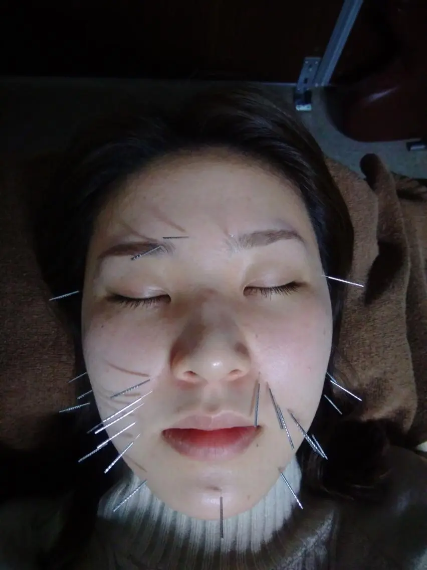 美顔鍼+KYT整体（20分）　45分の写真