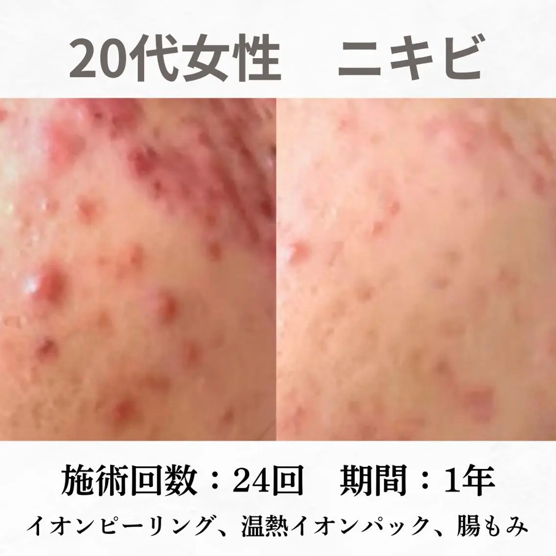 重度ニキビ専門🌷 ダウンタイムなしのエステ・リラクイメージ