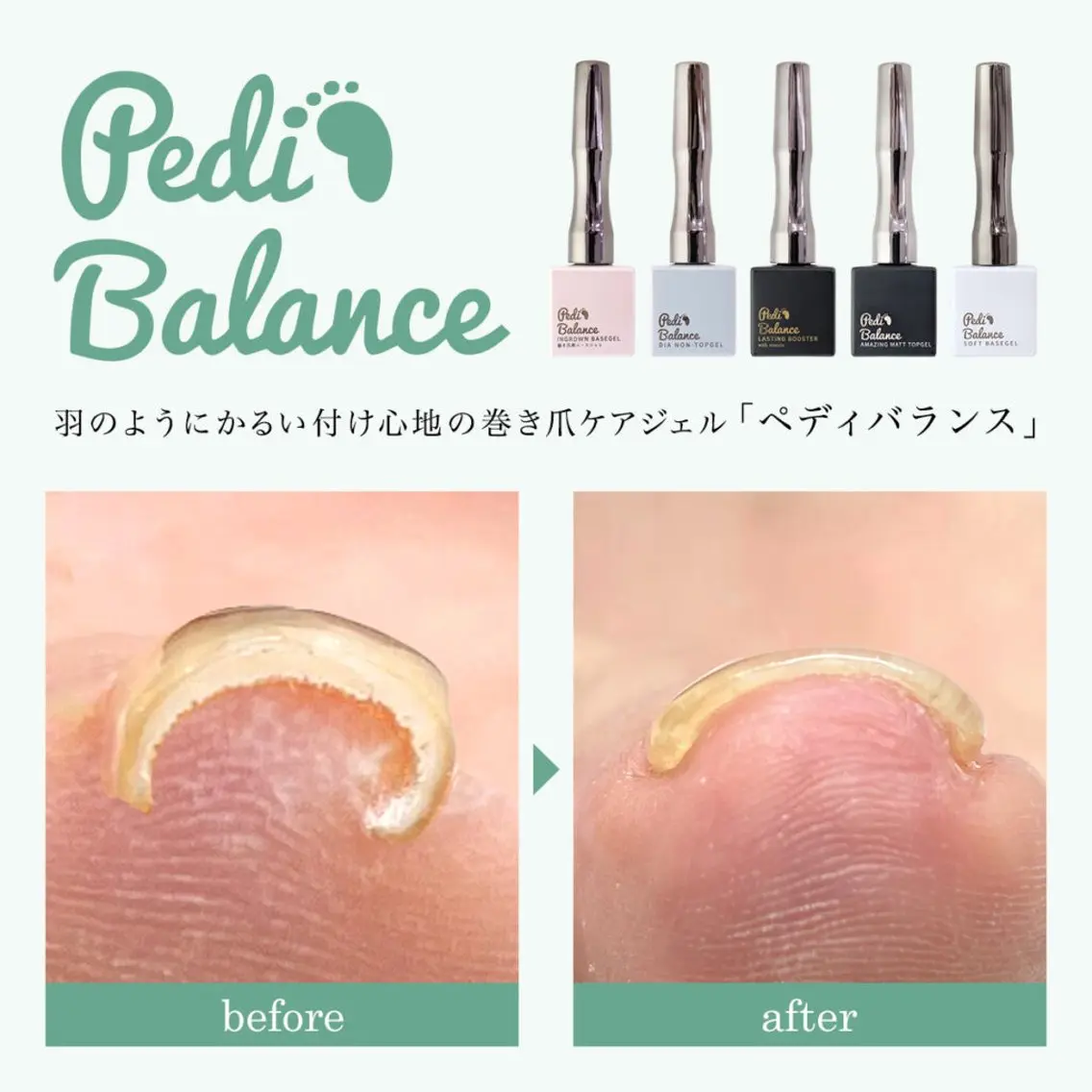 【最先端巻き爪ケア】ジェルを楽しみながら巻爪ケアできます❣️ペディバランス🐾の写真