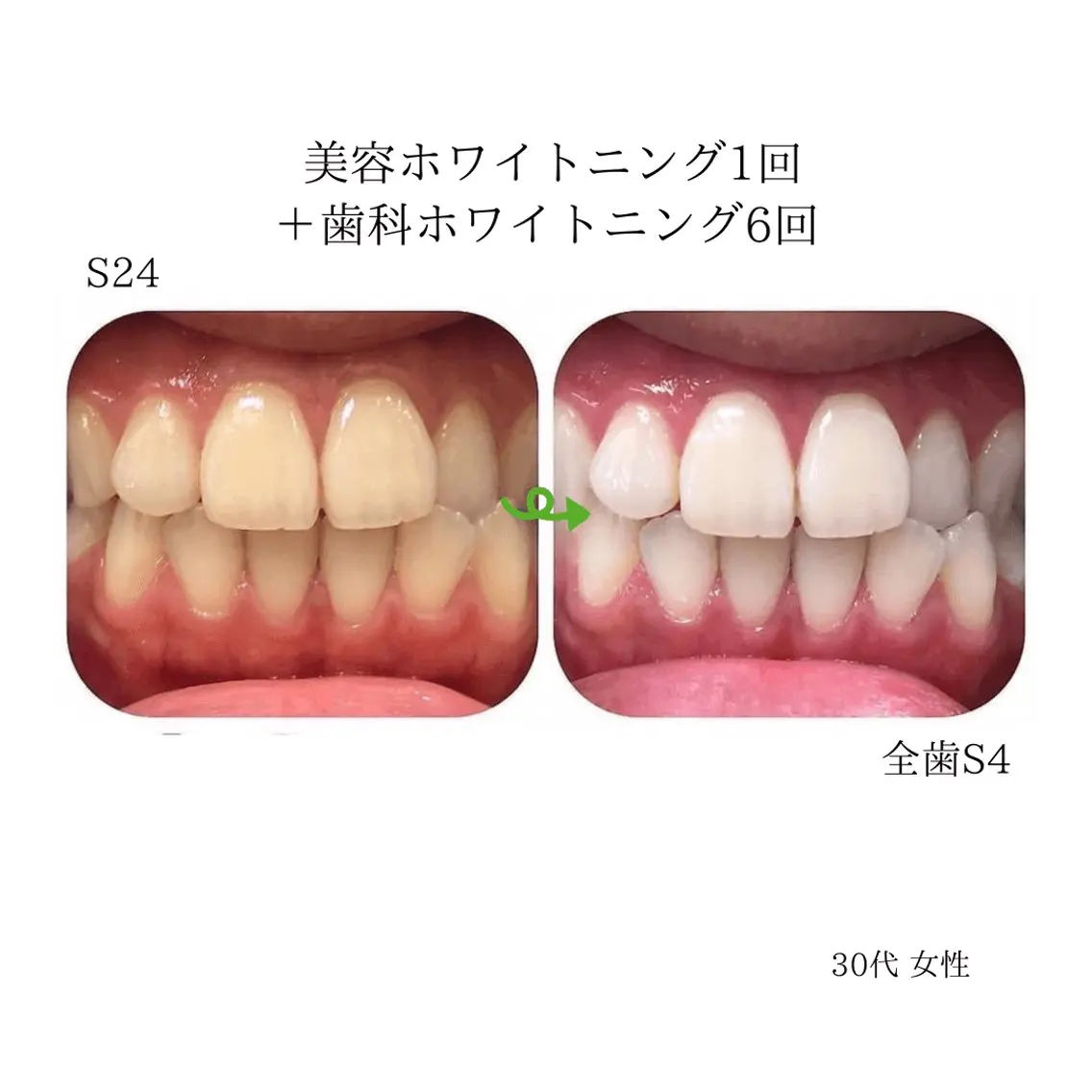 東区香椎歯のセルフホ ワイトニングGLOWのその他イメージ