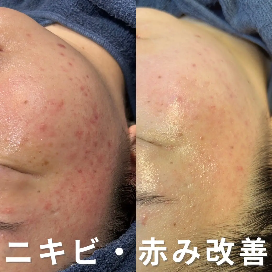 エステ ニキビ・ニキビ跡改善 leoloのエステ・リラクイメージ