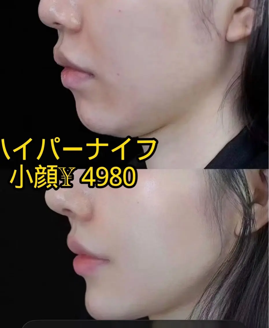 大人気🌸ハイパーナイフ小顔✨コルギとスキンケア込み✨50分¥ 4980の写真