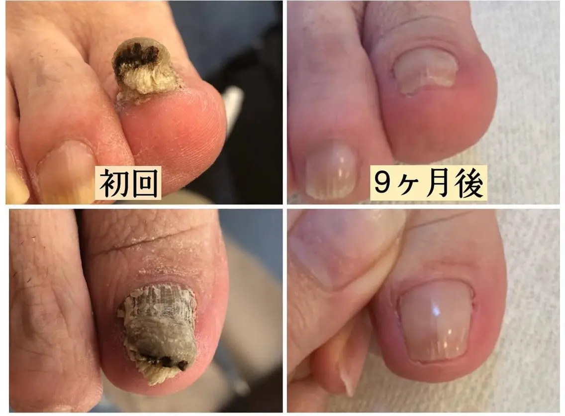 肥厚爪、変形爪ケアの写真