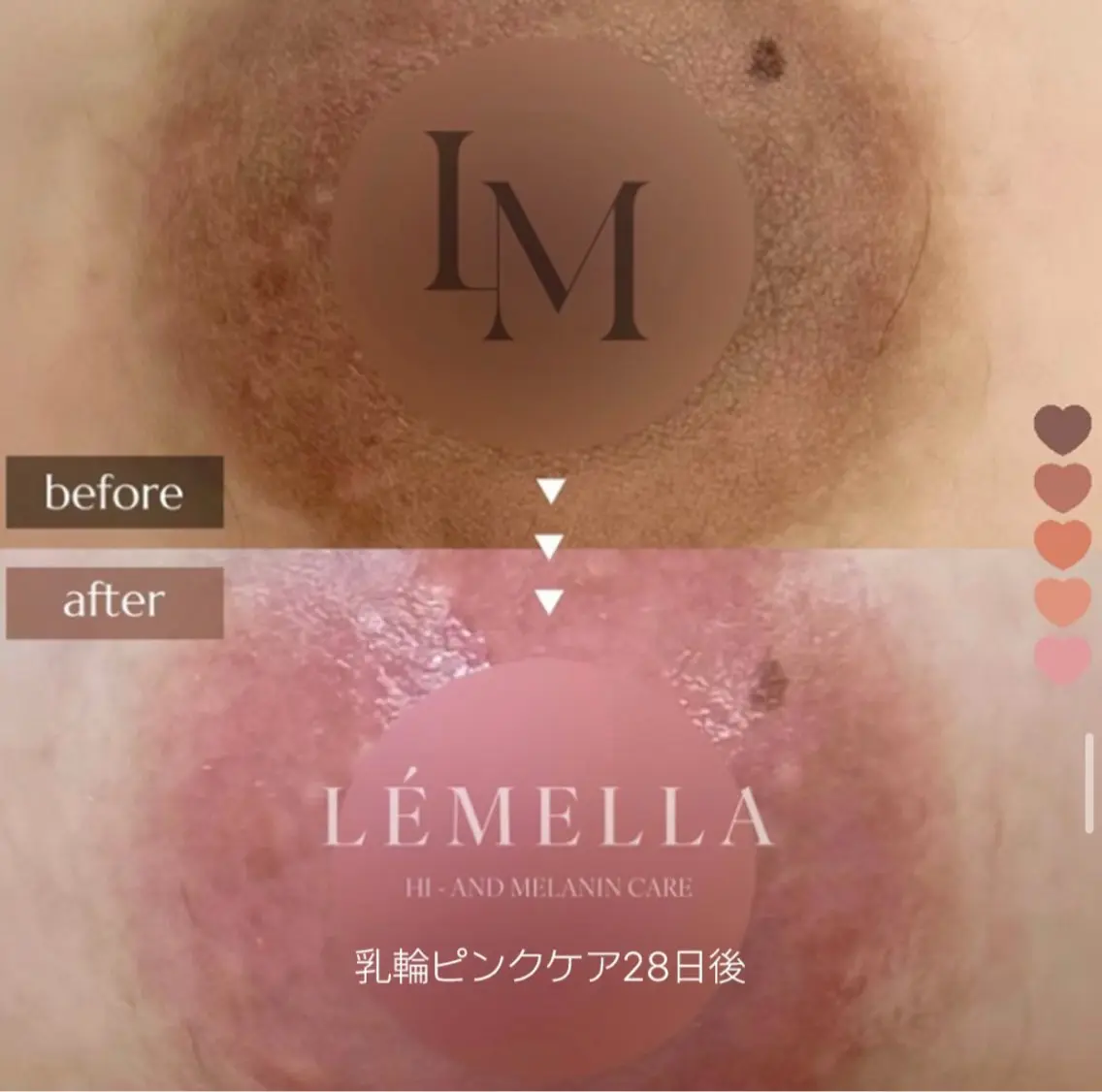 ルメラ🧸5月限定(乳輪)半永久!¥100,000→¥60,000モニターさん募集の写真