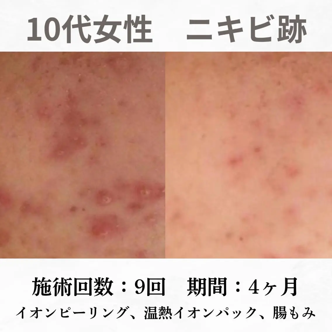 重度ニキビ専門🌼 ダウンタイムなしのエステ・リラクイメージ