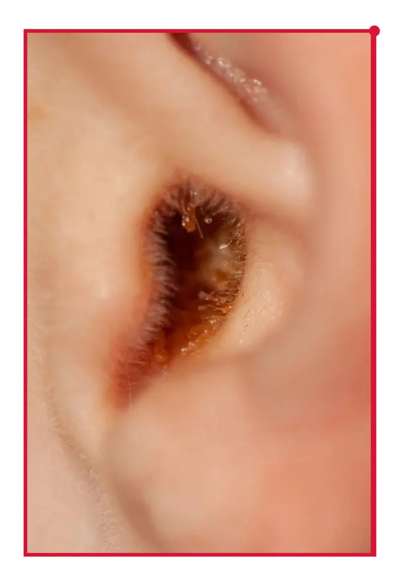 6月末までキャンペーン‼️あと17名限定❣️耳そうじ👂 イヤースコープ付き耳かき✨の写真