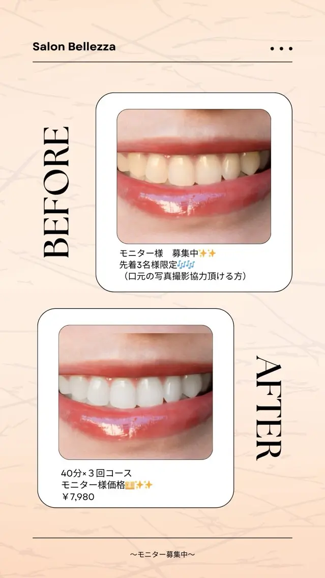 【モニター様募集中】40分照射×３回コース※口元の写真撮影にご協力いただける方限定の写真